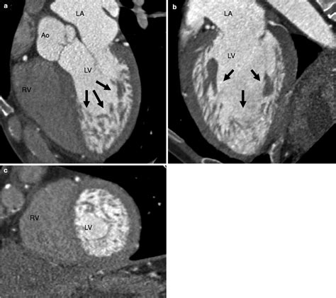 lv non compaction family screening|Left Ventricular Noncompaction: .